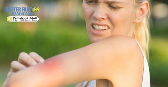 woman in pain scraching arm after a bug bite on her arm that is red and swollen