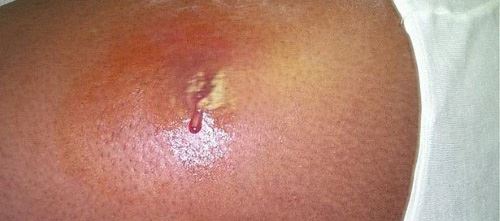 Image of an abscess in the skin
